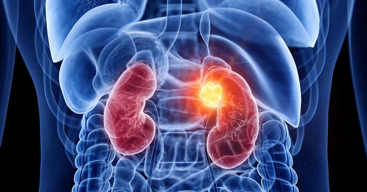 Current Management of Renal Cell Carcinoma Features Immune Checkpoint Inhibitors